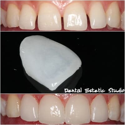 dental estetic