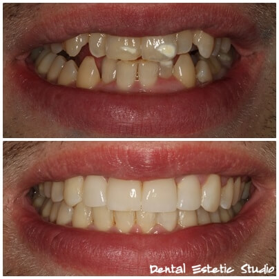 Orthodontic before after