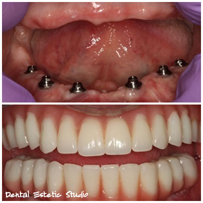 total dentures