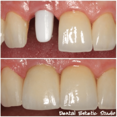 Implantat i abutment