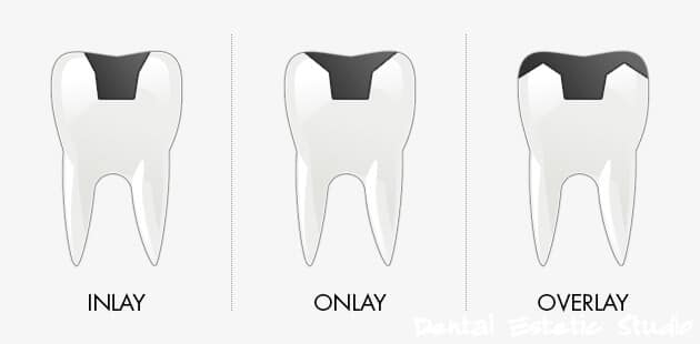 INLAY, ONLAY, OVERLAY