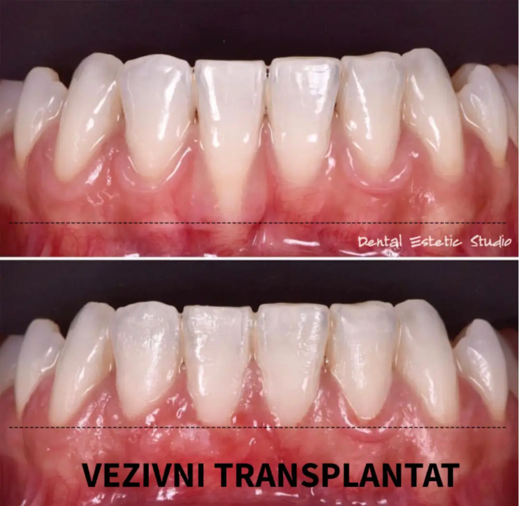 povlačenja gingive riješeni mikrokiruškim zahvatom vezivnim transplantatom