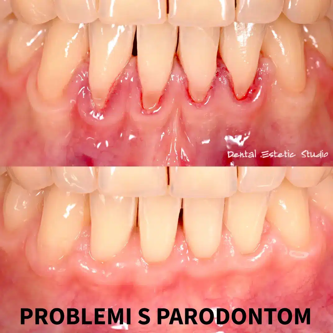 problemi s parodontom